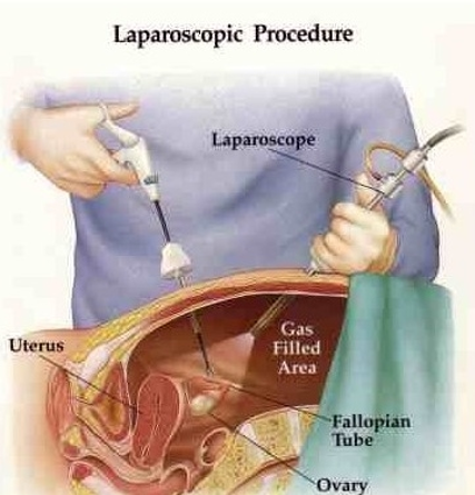 Laparoscopic surgeries