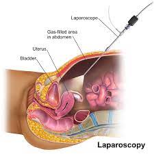 advanced colonic and gastric onco surgeries laparoscopically.