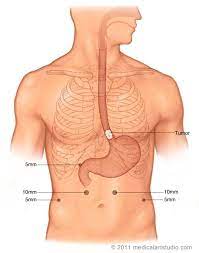 esophegectomy