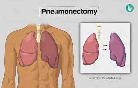 pneumonectomy by vats