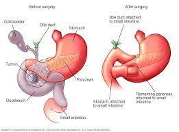Whipples Surgery